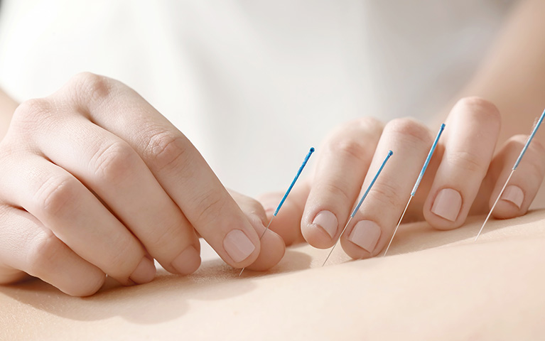 Performing an Acupuncture Session